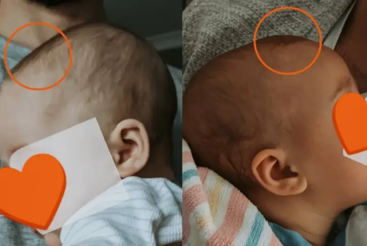 Dwa ujęcia główki niemowlaka, pokazujące jak zarasta ciemiączko. Widoczne są różnice w jego wielkości.